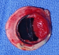 Điều trị cấp cứu huyết khối van tim nhân tạo bằng thuốc tiêu sợi huyết